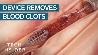 How This Device Safely Removes Blood Clots  Tech Insider [upl. by Eimyaj929]