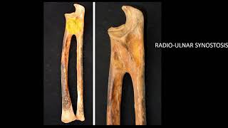 CONGENITAL RADIOULNAR SYNOSTOSIS  FRCS ORTHOPAEDIC LECTURE DNB ORTHOPAEDIC [upl. by Tsnre155]