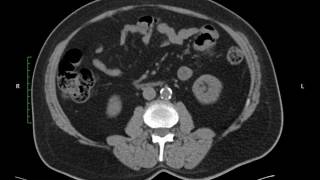 Ct Urogram Non contrast [upl. by Butterfield]