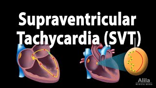 Supraventricular Tachycardia SVT PSVT Animation [upl. by Liman401]