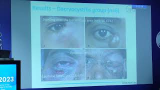 AIOC2023 Freepaper Lacrimal FP2133 topic Sphingomonas paucimobilis related lacrimal infections [upl. by Akkin]