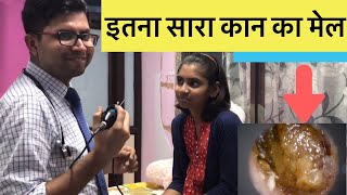 How to Remove Earwax best and easy way without pain [upl. by Epifano]