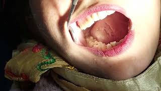 Deep Tooth Cavity  Healed wiothout a Root Canal [upl. by Finny209]