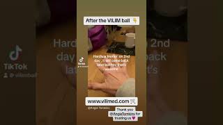 Hand tremor after using the VILIM ball essentialtremor et movementdisorders parkinsonsdisease [upl. by Naginarb]