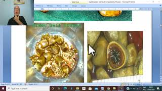 Biliary disorders in Arabic 1  Types of Gall Bladder Stones   by Dr Wahdan [upl. by Boris]