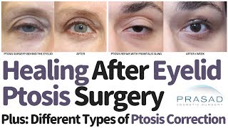 Different Types of Eyelid Ptosis Surgical Correction Techniques and Expected Healing Time [upl. by Adnoryt]