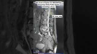 MRI Lumbar Spine Sagittal Section Showing likely Potts Spine t2tsesag Sequence beginners [upl. by Dunaville]