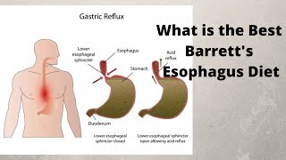 What is the Best Barretts Esophagus Diet [upl. by Isabel642]