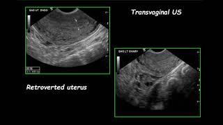 ultrasound of uterus [upl. by Rozek]