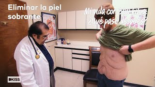 Operación para eliminar el exceso de piel  Mi vida con 300 kilos ¿Qué pasó después [upl. by Neeoma]