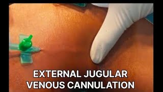 THIS IS HOW EXTERNAL JUGULAR VENOUS CANNULATION IS DONE [upl. by Terej]