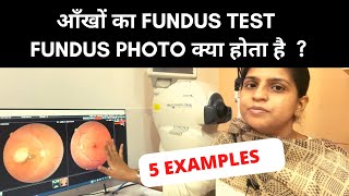 Fundus Test  Fundus photo Kya hota hai Total Eye Care Kolkata [upl. by Mccord602]