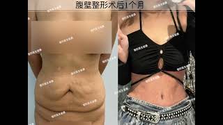 Abdominoplasty surgery can give you a perfect body shape [upl. by Ahsykal]