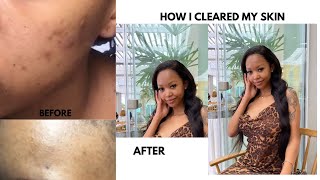 HOW I CLEARED MY ACNE USING ORATANE [upl. by Champagne59]