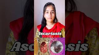 Ascariasis  protozoan disease🦠causes symptoms  transmission ascaris neet biology shortvideo [upl. by Leerzej903]