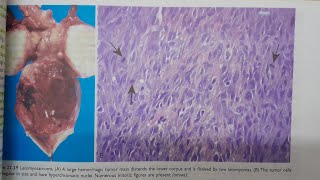 Leiomyosarcoma  SPECIAL PATHOLOGY [upl. by Aretina]