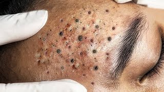 Blackheads amp Acne Treatment 01052024 Part 1 [upl. by Woodford]