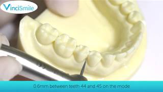 Work Tips Interproximal Enamel Stripping IPR） [upl. by Tarttan]