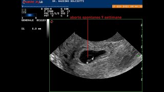 aborto spontaneo alla nona settimana di gestazione [upl. by Oileve]