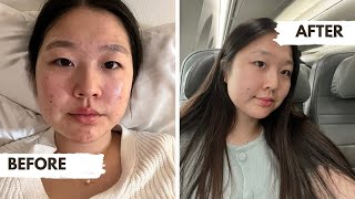 My Acne Journey  Korean Skincare [upl. by Norrek]