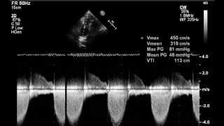 Valvular pulmonary stenosis [upl. by Teece149]