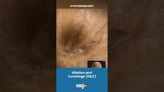 बच्चेदानी Uterus का Dilation और Curettage  Procedure for removing unwanted tissue in uterus [upl. by Conlon644]