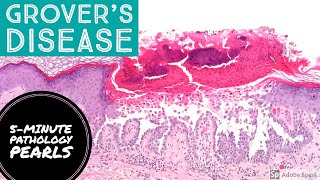 Grovers Disease Transient Acantholytic Dermatosis 5Minute Pathology Pearls [upl. by Anohr783]