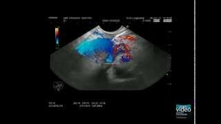 Advanced EUS imaging CEEUS lowMI high MI including 3D techniques in pancreatic imaging [upl. by Deach]