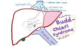 BuddChiari syndrome  Definition Causes Pathophysiology Diagnosis amp Treatment  Hepatology [upl. by Bernadene]