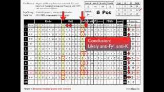 Antibody ID Basic Cases Part 2 [upl. by Ylek]