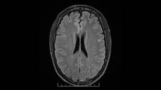 MRI showing progressive multifocal leukoencephalopathy [upl. by Luehrmann]