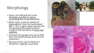 Lecture3  Pathological calcification Gangrene Adaptation [upl. by Mulford]