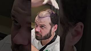 Hair Transplant 5 month Result  Hair Transplant Timelapse  Hair Transplant in Turkey [upl. by Aniretak349]