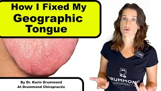 Geographic Tongue  Natural Remedies That Work [upl. by Milinda]