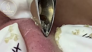 Nose Zone Precision Blackhead Extraction [upl. by Ailecara727]