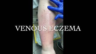 Venous Stasis Venous Eczema amp Venous Insufficiency [upl. by Thurman]