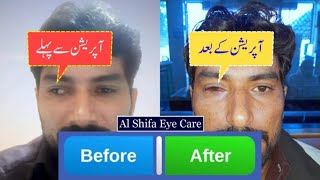 CrossedSquint Eyes Treatment  4045 Degree Squint Correction Surgery in Pakistan [upl. by Atiuqan464]