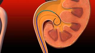 Ureteral Obstruction  Retrograde insertion of Resonance stent [upl. by Atnohsal]