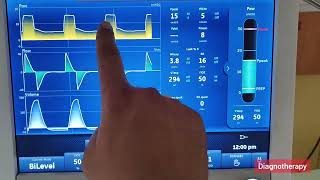 BiPAP Bilevel Positive Airway Pressure BiPAP in Hindi  Biomedical Engineering  Diagnotherapy [upl. by Eniak261]