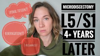 Update 4 years after microdiscectomy at L5S1 Reherniation [upl. by Streeto]