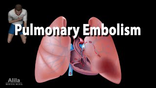 Pulmonary Embolism Animation [upl. by Brey]