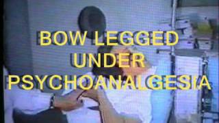 Dr Escudero  BOW LEGGED UNDER PSYCHOANALGESIA Genu Varum operado con psicoanalgesia [upl. by Lerej]