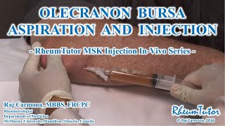 OLECRANON BURSA ASPIRATION  INJECTION  InVivo Series [upl. by Ahsircal]