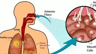 MEDICINE Lectures  Respiratory  TP 1  Occupational Lung Disease  ASBESTOSIS [upl. by Clementine]