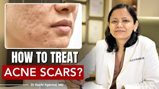 How to treat Acne Scars  Acne Scar Treatment  Acne Scars  Dr Ruchi Agarwal  Satya acnescars [upl. by Eadith687]