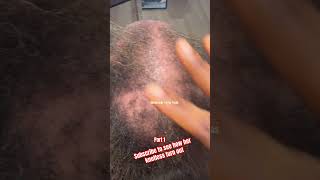 braids alopecia haircare knotlessbraids braidedhairstyles hairloss hair thinning how to [upl. by Illil]