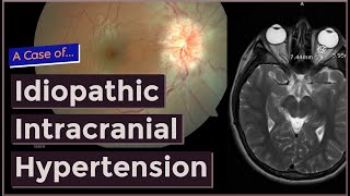 Idiopathic Intracranial Hypertension [upl. by Rehpotsirhk380]