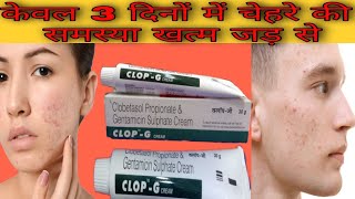 ClopG cream use review benefits side effects includingकेवल 3 दिनों में चेहरे की समस्या खत्म जड़ से [upl. by Liagibba]