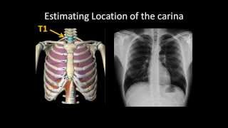 Basic Chest Radiology ET Tube Position and Complications [upl. by Erminia]