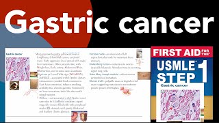 Gastric cancer Laurans pathological classification in HindiUrdu by first aid for USMLE step 1 [upl. by Llerrehc]